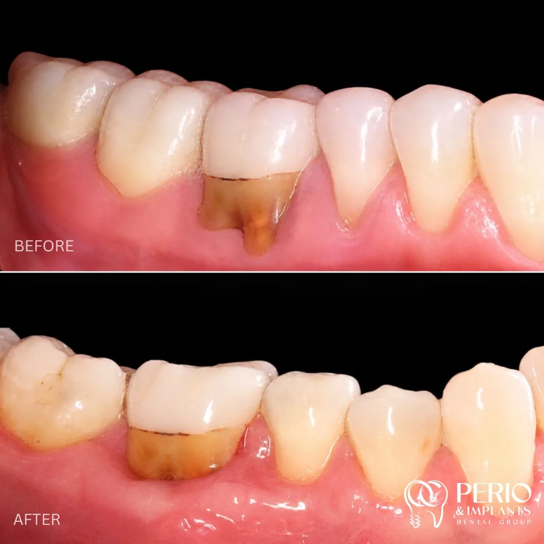 Before and after - Gingival Recessions