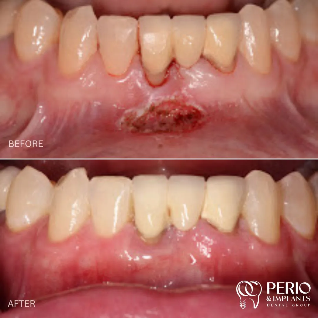 Before and after - Gingival Recessions