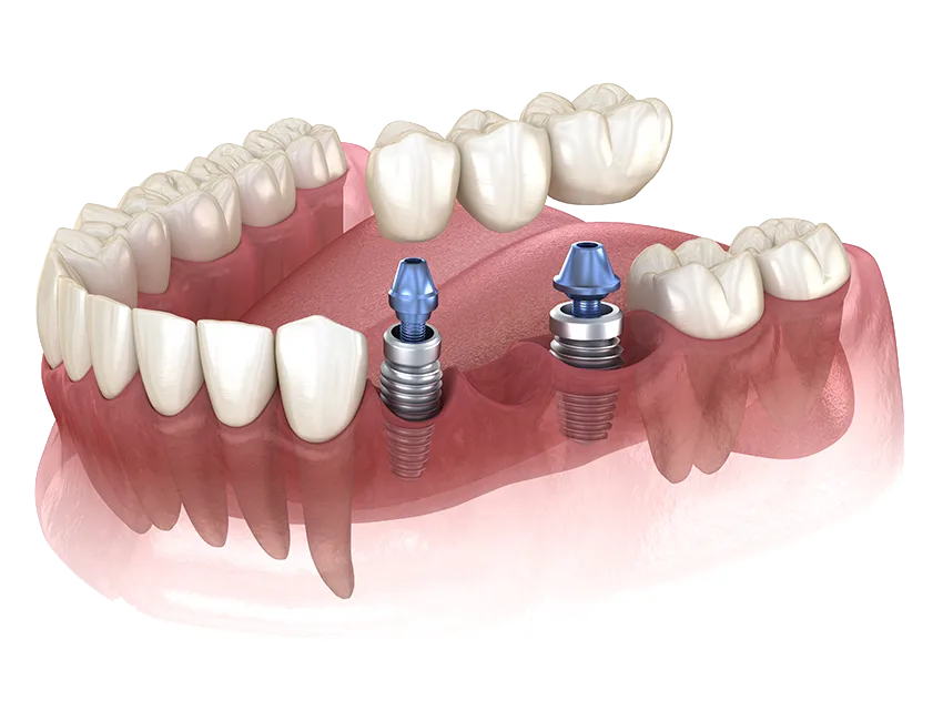 Implant-Supported Bridges