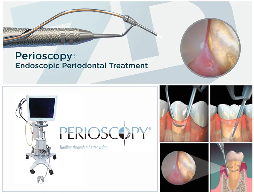 What is Perioscope