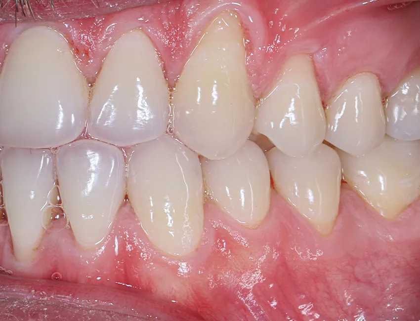 The benefits of Gum Grafting
