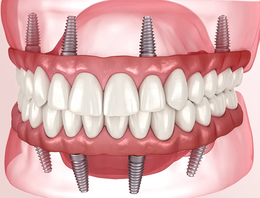 What is Same-Day Dental Implants