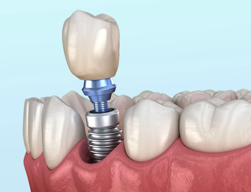 Dental Implant 3D model