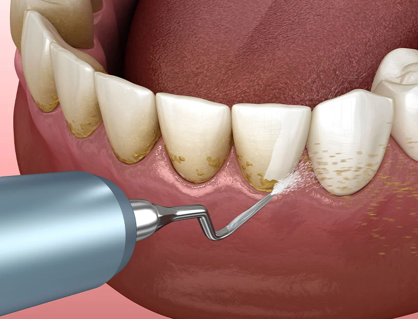 Dental Cleaning