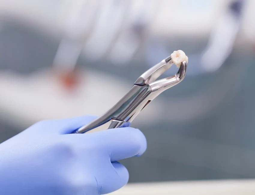 Tooth Extraction