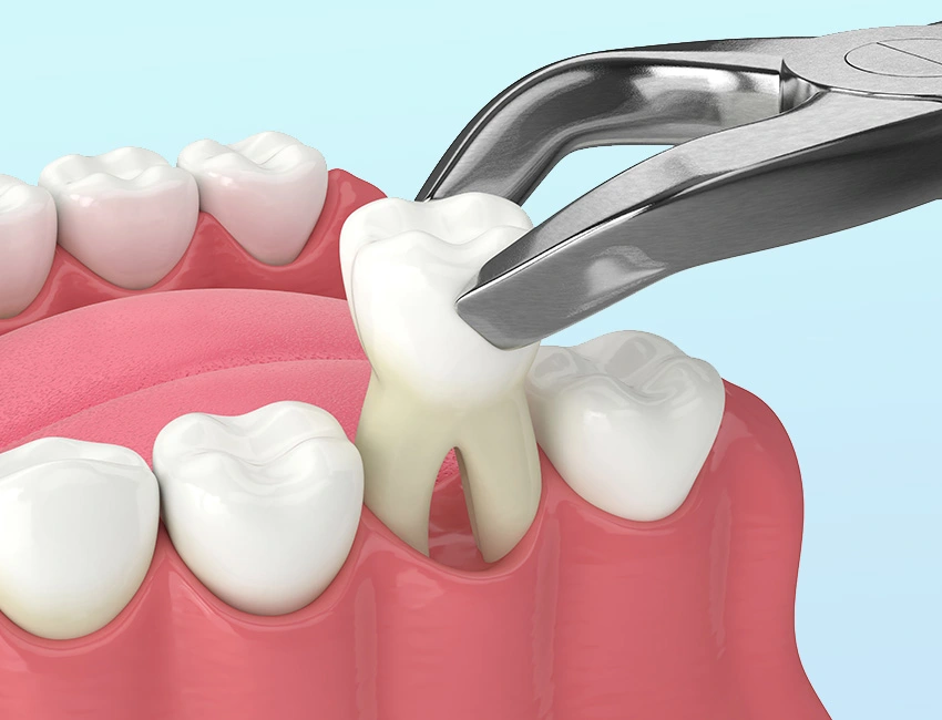 The benefits of Tooth Extraction
