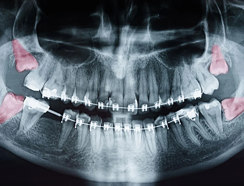 The benefits of Wisdom Teeth Removal